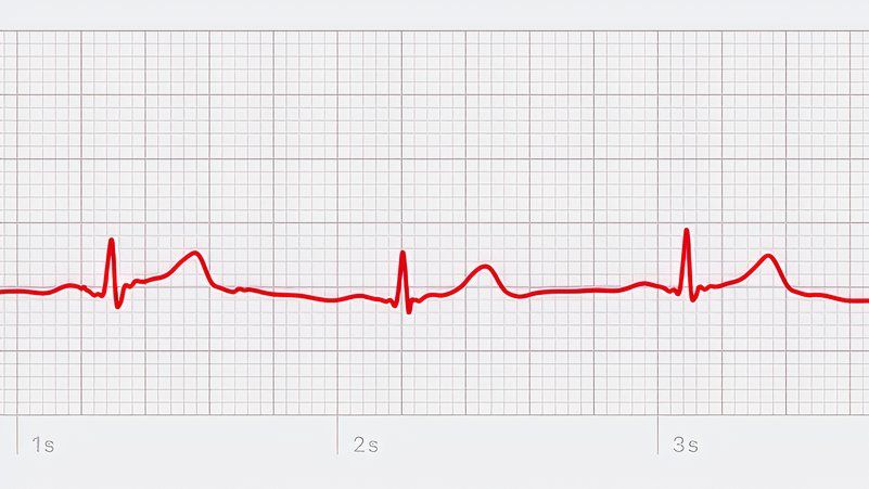 Heart electrocardiogram example.